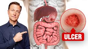 the fastest way to heal an ulcer you