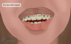 braces wrecking your lips here s how