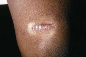 keloid scars risks causes prevention