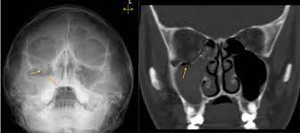 orbital out fracture radiology at
