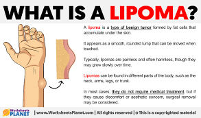 what is a lipoma definition of lipoma