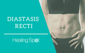 what is diastasis recti how does it