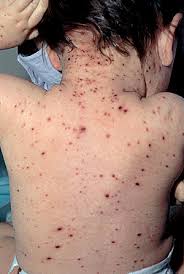 Resultado de imagen para imagenes de enfermos de varicela