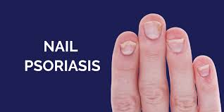 nail psoriasis psoriasis treatment