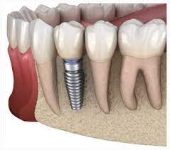 dental implants treatment and cost in