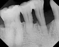 Dental X Ray Exposure Fears Total Mouth Fitness