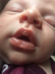 baby blister on top lip babycenter