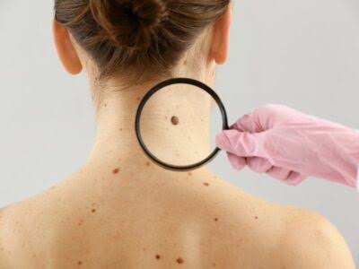 Signs of Skin Cancer: Unusual Spots, Bumps, And Moles To Watch Out For