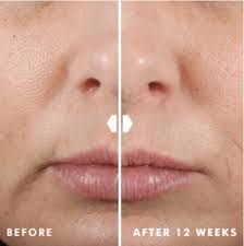 Treat with skinceuticals retinol 0.3 refining night treatment. The Science Behind Skinceuticals Hyaluronic Acid Intensifier Derm Talk