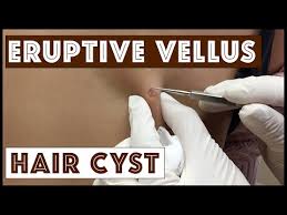 cysts eruptive vellus hair cysts