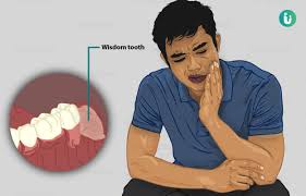 wisdom tooth pain symptoms causes