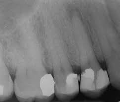 Among adults, it is estimated that around 70% of tooth loss is caused by. Periodontal Disease Wikipedia
