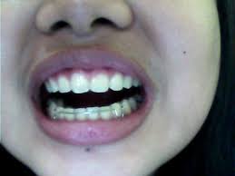 How long after braces do you need to wear your retainer? Will Retainers Shift Teeth Back Into Place 6 Months After Braces Photo