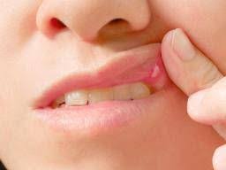canker sore on lip causes risk