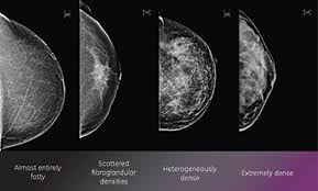 Breast Density Why It Matters