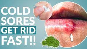 how to get rid of cold sore fast you