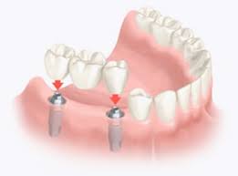 multiple tooth replacement west palm