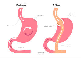 gastric byp vs gastric sleeve