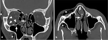 traumatic orbital emergencies