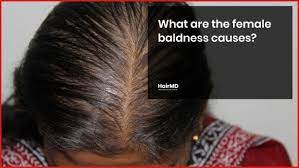 what are the female baldness causes