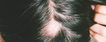 autoimmune hair loss causes symptoms