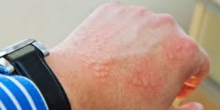 urticaria hives nettle rash