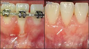 Gingivitis is caused by inflammation of the gums. I Got My Braces Off Today But My Gums Are Really Swollen And It Looks Awful How Can I Get Rid Of The Swelling Fast Quora