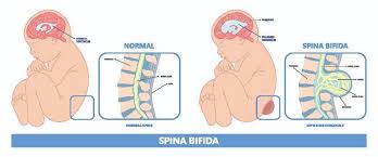 spina bifida the ultimate guide for