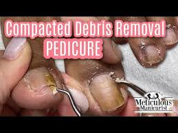 deep pedicure cleaning and compacted