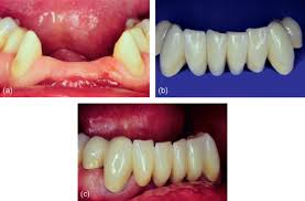 fixed partial denture an overview