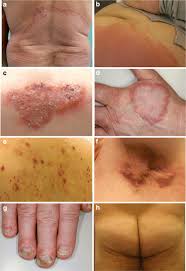 skin diseases a tinea corporis