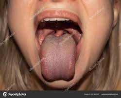 pain sore throat open mouth red throat