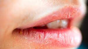 ed lips symptoms causes treatments