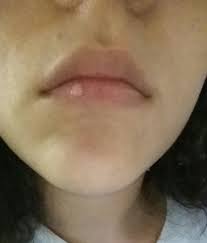can the white scar on my bottom lip be