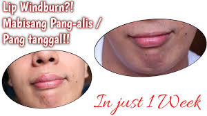 lip windburn remedy easy and