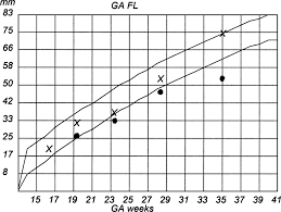 Growth Chart Showing Femur Length Versus Gestational Age