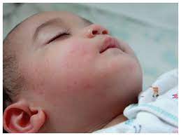 itchy skin in newborns