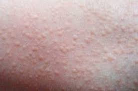 5 common skin conditions rashes in