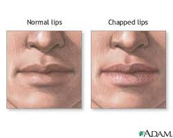 chapped lips medlineplus cal