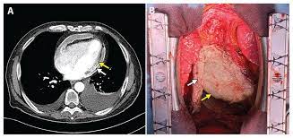 The condition usually clears up after 3 months, but sometimes attacks can come and go for years. Constrictive Pericarditis With Pericardial Calcification Cmaj