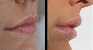 lip augmentation nyc nyc lip