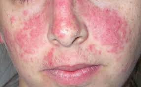 malar rash an overview