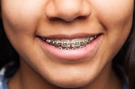 A common question we always get is do braces hurt? in this video, dr jenny zhu will answer the question and provide some pain management tips on how to. Thinking About Getting Braces Read This Do Braces Hurt Sandia Dental Care Albuquerque Dentist