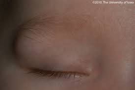 dermoid cyst eyerounds org