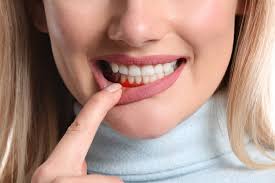 inflamed gums gingivitis causes