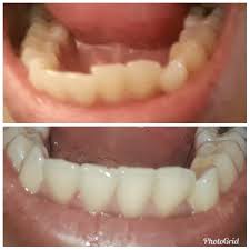 But how exactly does a retainer work? Teeth Shifted After Braces Teethwalls