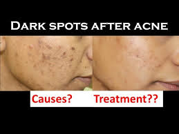 dark spot after acne post inflammatory