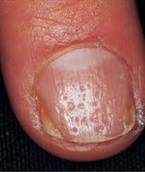 diffeial diagnosis of nail pitting