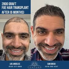 Does stem cell therapy work hair loss? Concord Hair Restoration And Stem Cell 46 Photos 19 Reviews Hair Loss Centers 16661 Ventura Blvd Encino Ca Phone Number Yelp