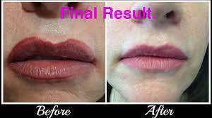 lip tattoo correction removal you